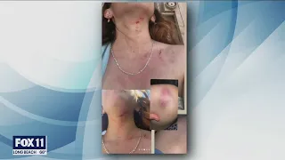 Teen girl fights off attackers in Long Beach