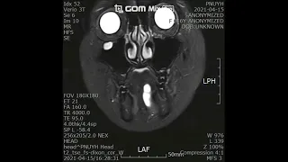 Excision of ranula