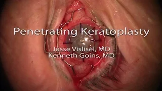 Penetrating Keratoplasty (PKP)