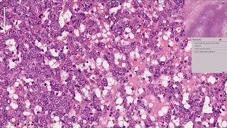 Reninoma / Juxtaglomerular Cell Tumor - Kidney, Histopathology