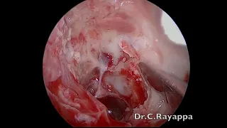 Optic nerve decompression