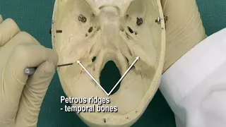 1.14 Step 20.  Cranial fossae; foramina of the anterior cranial fossa