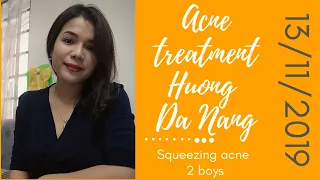 Squeezing acne 2 boys | 13/11/2019| Acne treatment Hương Đà Nẵng