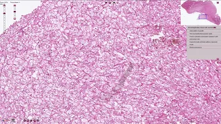 Chromophobe Renal Cell Carcinoma - Histopathology