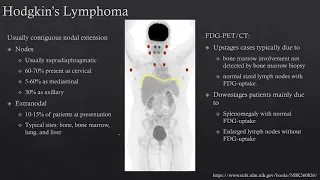 PET  CT imaging lymphoma