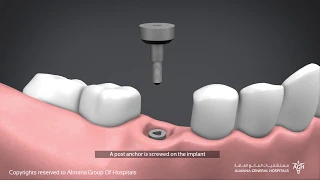كيف تتم زراعة الأسنان؟