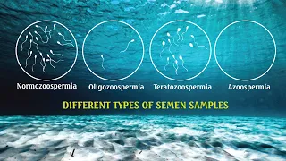 Semen analysis Samples- OLIGOZOOSPERMIA, ASTHENOZOOSPERMIA , TERATOZOOSPERMIA| SPERM COUNT
