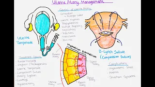 Understanding Uterine Atony and Ways to Treat it (Postpartum Haemorrhage)