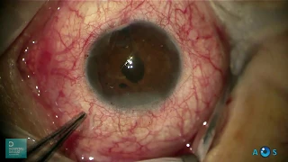 Pupilloplasty and Retropupillary Iris-Claw IOL for Aphakia due to blunt eye trauma 40 years ago!