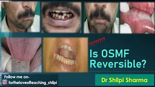 क्या OSMF पूरी तरह ठीक होता है और कितने दिन में ठीक होता है? | Is OSMF Reversible?