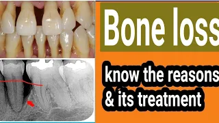 Bone loss in teeth; Dr. Praveen Bhatia