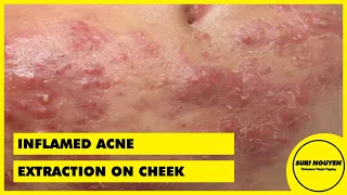 Suri Job 42: INFLAMED ACNE EXTRACTION ON CHEEK