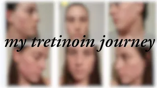 8 MONTH TRETINOIN JOURNEY// UNSPONSORED APOSTROPHE REVIEW