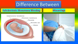 Distinction between Subchorionic Hematoma Bleeding  and  Miscarriage