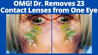 Unbelievable! Doctor Removes 23 Contact Lenses Eye, Video went Viral