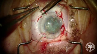 Psudoexfoliation Cataract with all of the Expected Complications