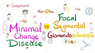 Minimal Change Disease (MCD) VS Focal Segmental Glomerulosclerosis (FSGS) | Nephrotic Syndrome