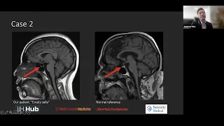 IIH: MRI Findings in a Patient with Blurry Vision, Headaches, Tinnitus and Papilledema on Fundoscopy