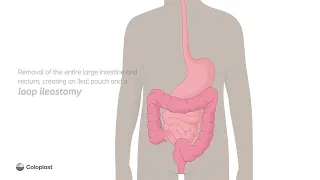 Creation of loop ileostomy by removing large intestine, rectum | Ostomy surgery | Coloplast India