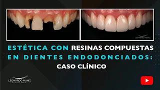 Estética con Resinas Compuestas en Dientes Endodonciados: Caso Clínico