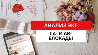 ЭКГ диагностика нарушений проводимости. АВ-блокады. СА-блокады.