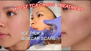 TCA CROSS FOR ACNE SCARS l Ice pick & Boxcar scars on Asian Skin