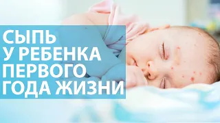 Сыпь у ребёнка до года