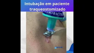 Intubação em paciente traqueostomizado - SAVeM (Suporte Avançado em Ventilação Mecânica)