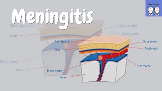 Meningitis [bacterial vs viral, symptoms, Kernig's sign, clinical clues, meningococcal infection]