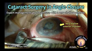 CataractCoach 1549: cataract surgery in angle closure glaucoma