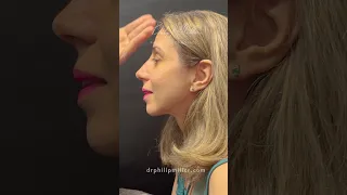 Cast Off Day! Gorgeous Rhinoplasty Results Revealed!