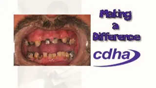 Meth Mouth - The oral affects of methamphetamine
