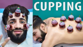 Wet Cupping Therapy  Hijama for Skin Care | My First Hijama Cupping