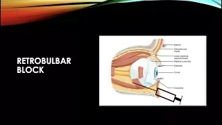 RETROBULBAR ANESTHESIA