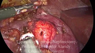 Laparoscopic partial Nephrectomy for renal tumor and renal cystاستئصال ورم الكلية الجزئي مع كيس كلية