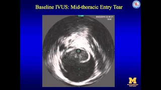 TEVAR for complicated acute type B dissection with malperfusion