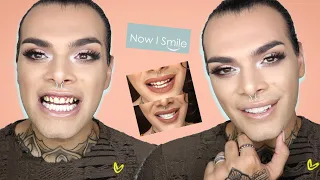 VENEERS BEFORE AND AFTER PICS + Q&A  - NOW I SMILE REVIEW