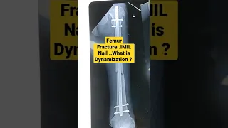 Femur Fracture..IMIL Nail ..What is Dynamization ?