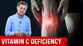 Could Your Joint Pain Be a Vitamin C Deficiency? – Dr.Berg