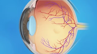 Torn Retina: Cryopexy