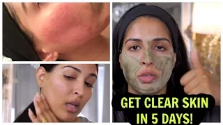 GET CLEAR SKIN IN 5 DAYS!