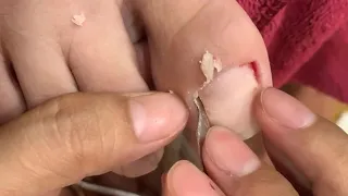 HOW TO CUT THICK TOENAILS - Toenail Cleaning Satisfying #202