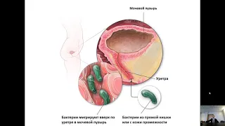 Хронический бактериальный цистит - причины и лечение.