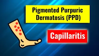 Pigmented purpuric dermatosis, Capillaritis: overview, clinical features, histology and management