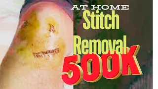 Skin stapler removal at home | Dr J K dada | MARATHI INFORMATION | SELF GUIDE | DIY | STITCHES CARE