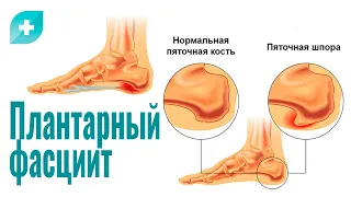 Плантарный фасциит: причины, симптомы и лечение