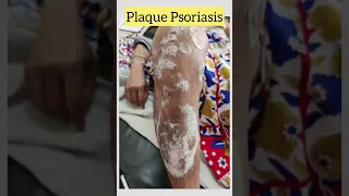 Psoriasis | psoriatic plaques | white Scaly skin lesions. 🩺#psoriasis  #skin 🤔 #disease #shorts