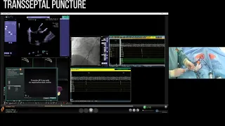 Full Procedure Cardiac Ablation, #1 of 6 of Master Class in Supreme Efficiency in Robotic EP