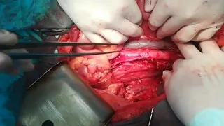 Radical nephrectomy with left colectomy for advanced kidney cancer