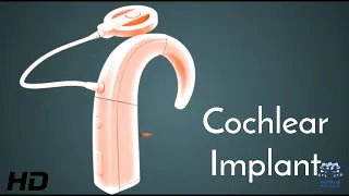 Cochlear Implants: Enhancing Communication and Quality of Life